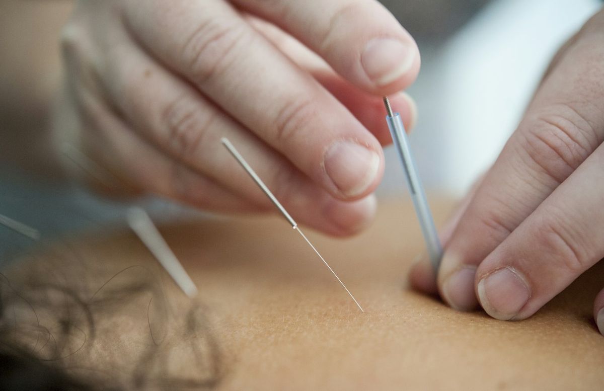 Sesión de acupuntura en FluxusTerapia